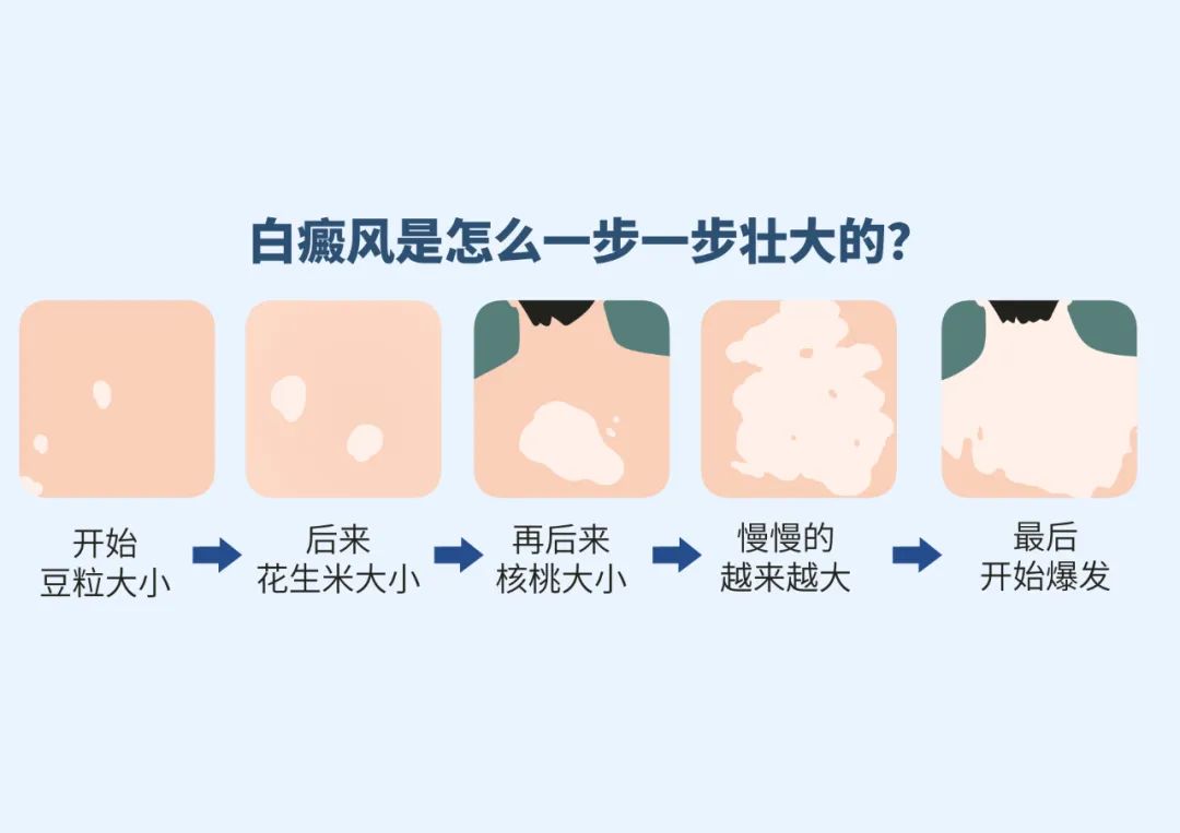 12白癜风扩散的几个 信号 临沂皮肤病医院哪家好