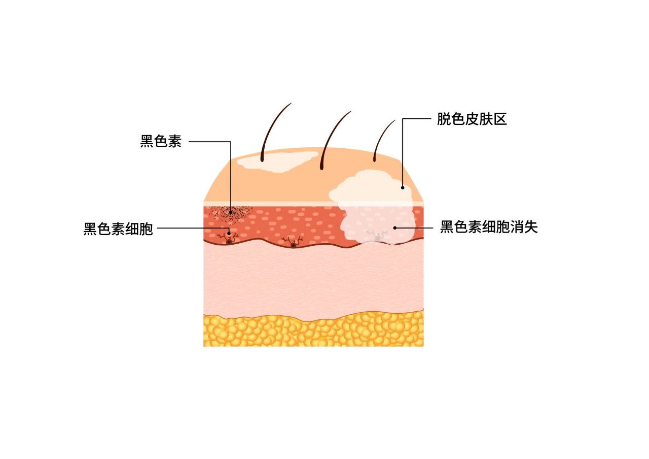 白癜风9